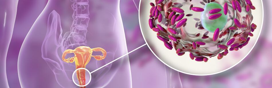 bakterielle-vaginose-zb2