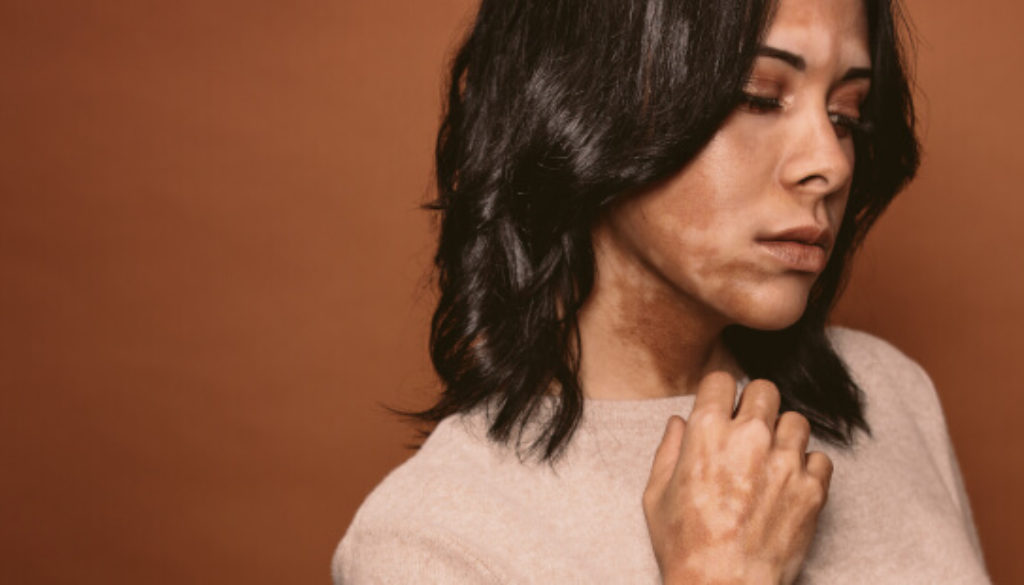 vitiligo-zb1